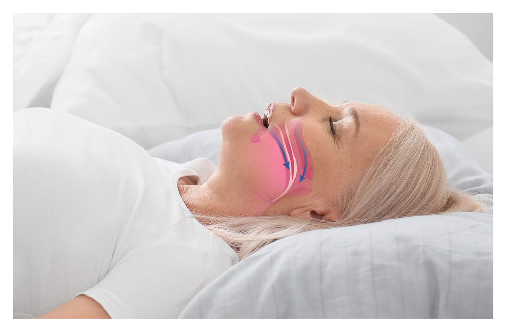 sleep apnea therapy
